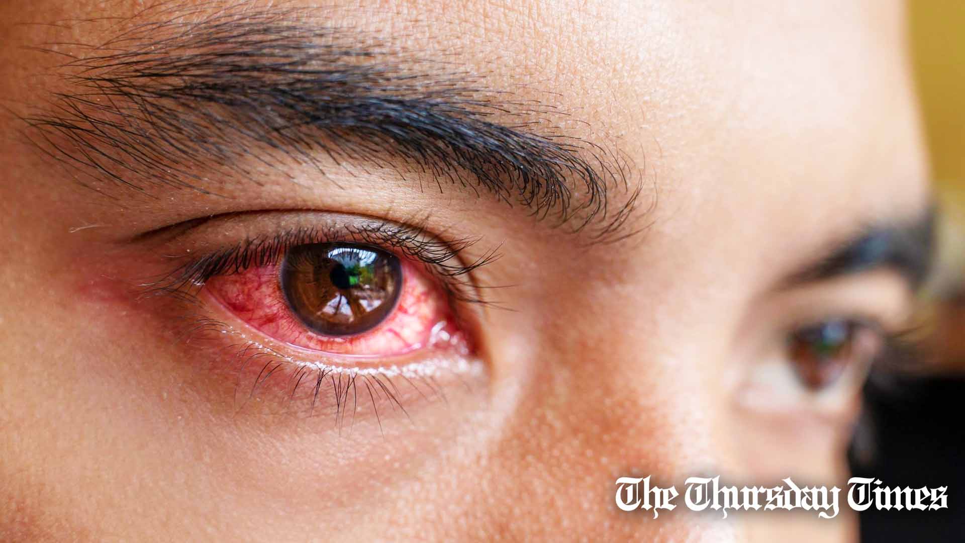 A file photo is shown of a patient with conjunctivitis. — FILE/THE THURSDAY TIMES