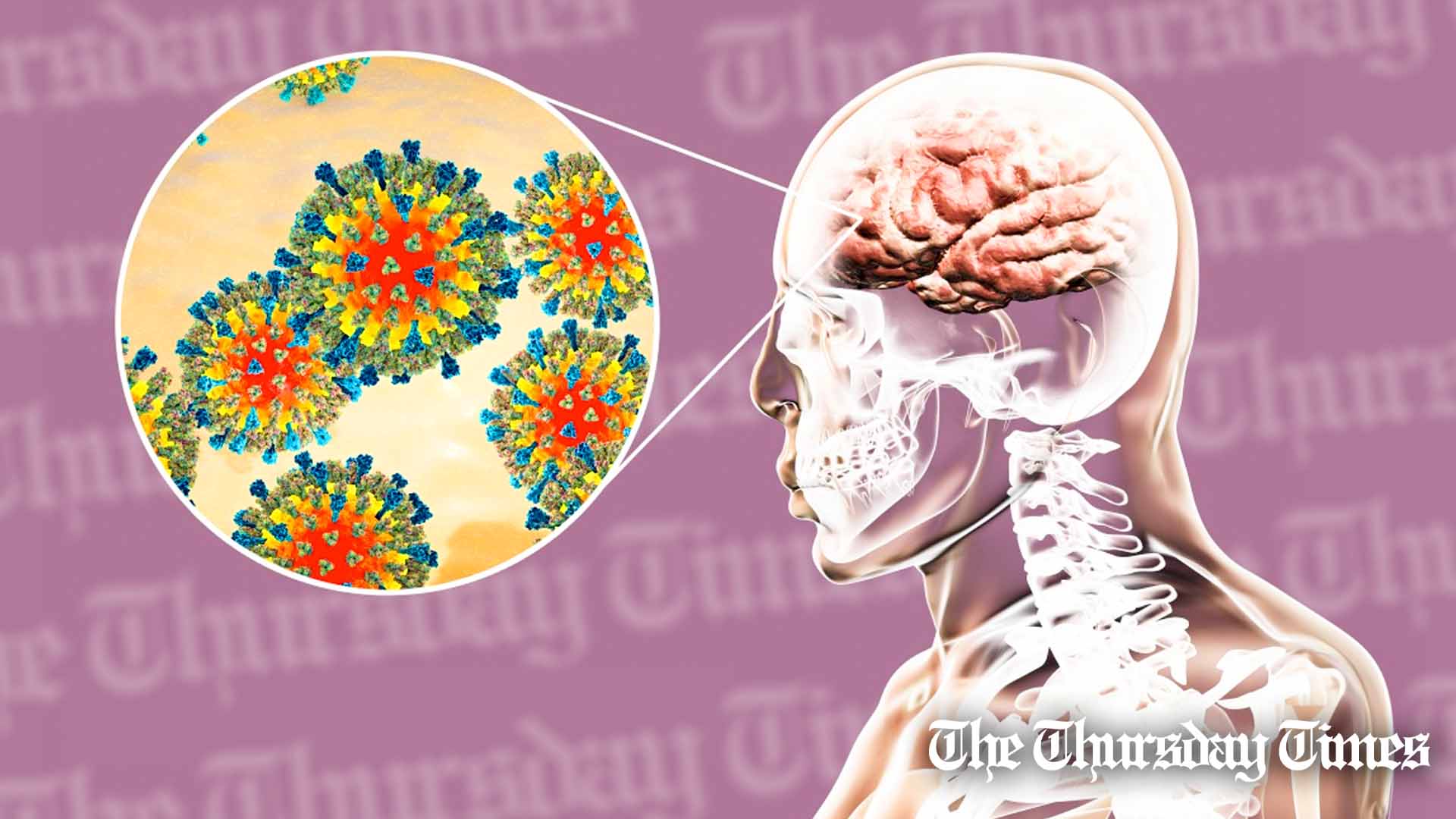 An illustration is shown of a patient with SSPE. — FILE/THE THURSDAY TIMES
